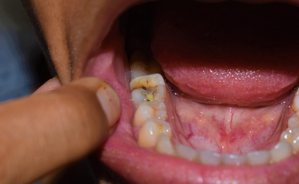 Teeth Pain Relief: दाढ़ का दर्द जड़ से खत्म कैसे करें?, डॉक्‍टर ने बताया क्‍यों और कब दाढ़ निकाली जानी चाहिए