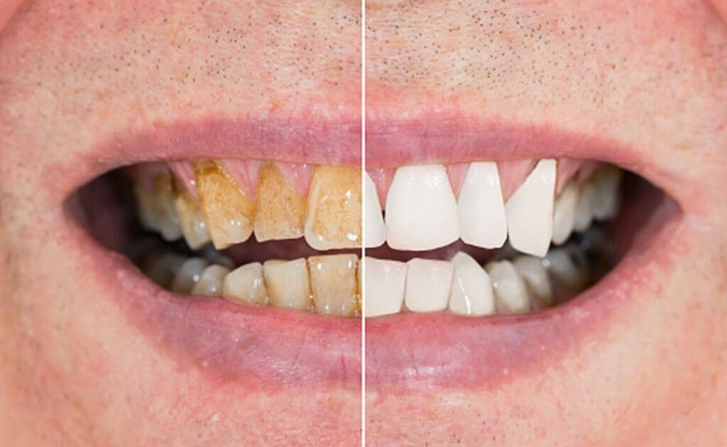 Teeth Whitening Tips: पीले दांतों को साफ कैसे करें? 4 तरह से करें बेकिंग सोडा का इस्तेमाल, मोतियों से सफेद होंगे पीले दांत